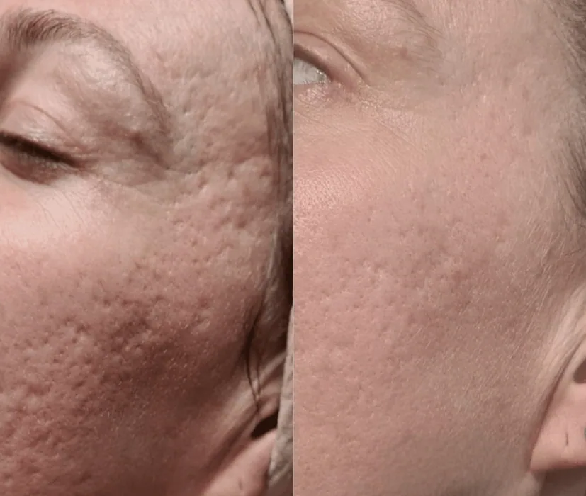 Antes y después de marcas de acné con Porcelaine