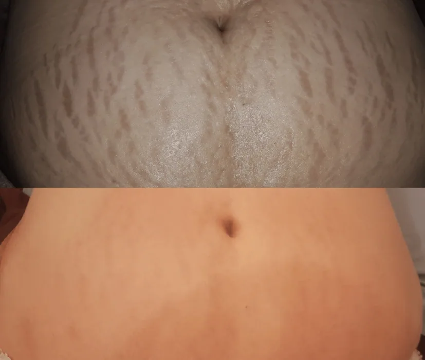 Antes y después de estrías con Porcelaine corporal