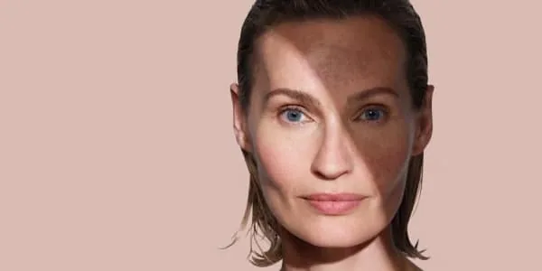 Manchas y melasma en el rostro