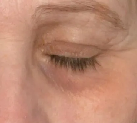 Contorno de ojos antes del tratamiento