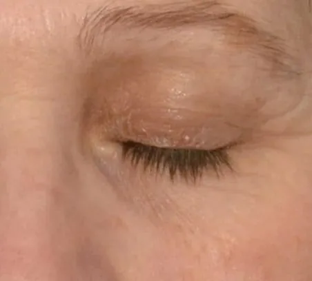Contorno de ojos después del tratamiento